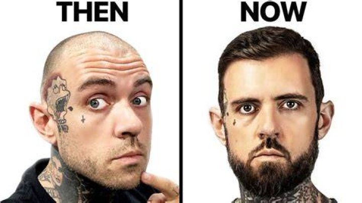 Adam22 Had 2 Hair Transplants Surgeon Reacts YouTube