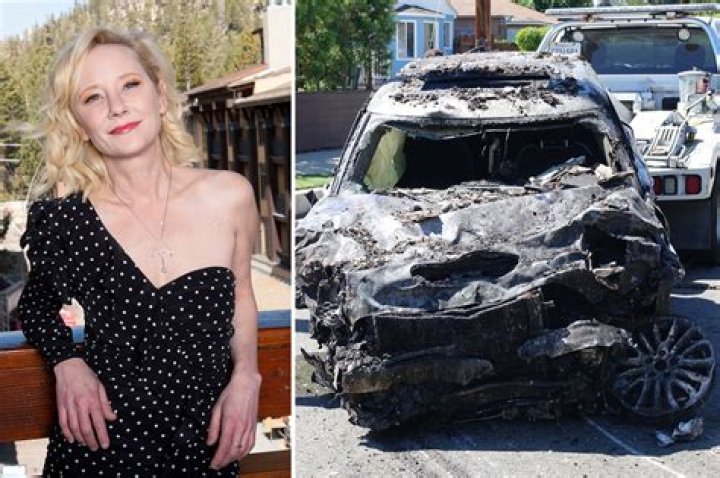 Anne Heche was severely burned after crashing her car into a Los