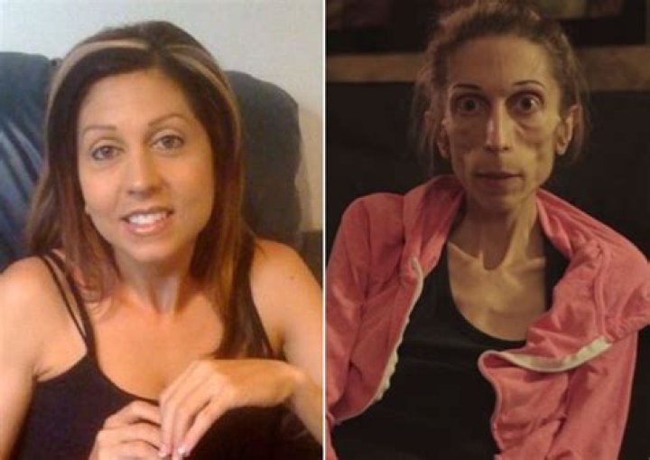 Anorexic woman Rachael Farrokh, who weighs just 40lbs, raises over