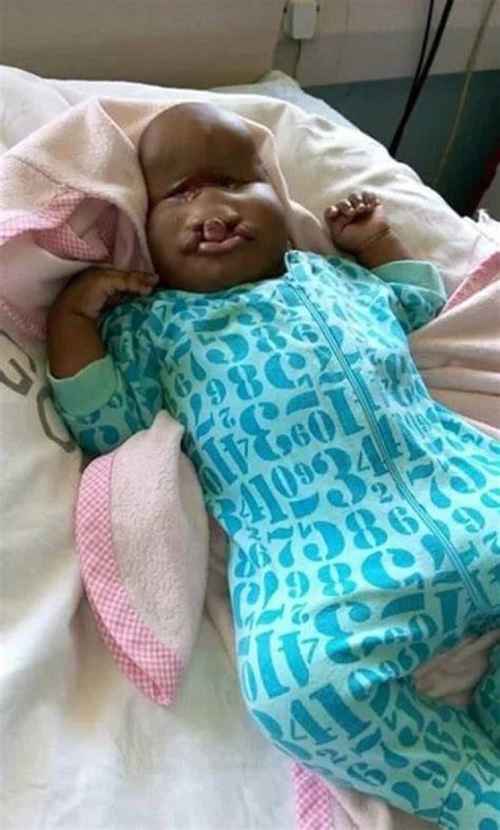 Baby born with severe facial deformities in Kenya shunned by parents
