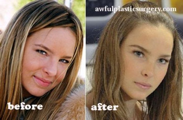 Belinda Peregrin Nose Job Plastic Surgery Before And After Photos