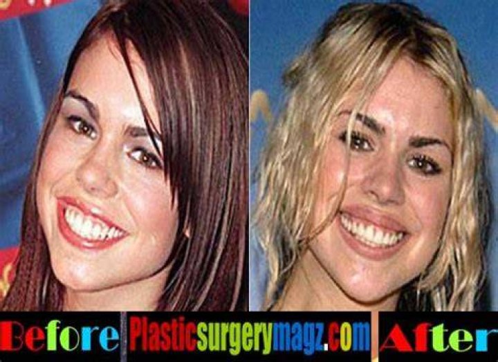 Billie Piper Plastic Surgery LearningJoan
