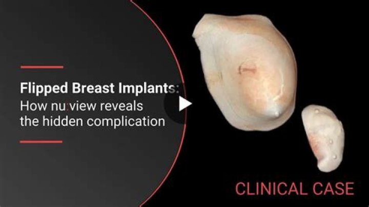Breast Implant Flipped or Rotated