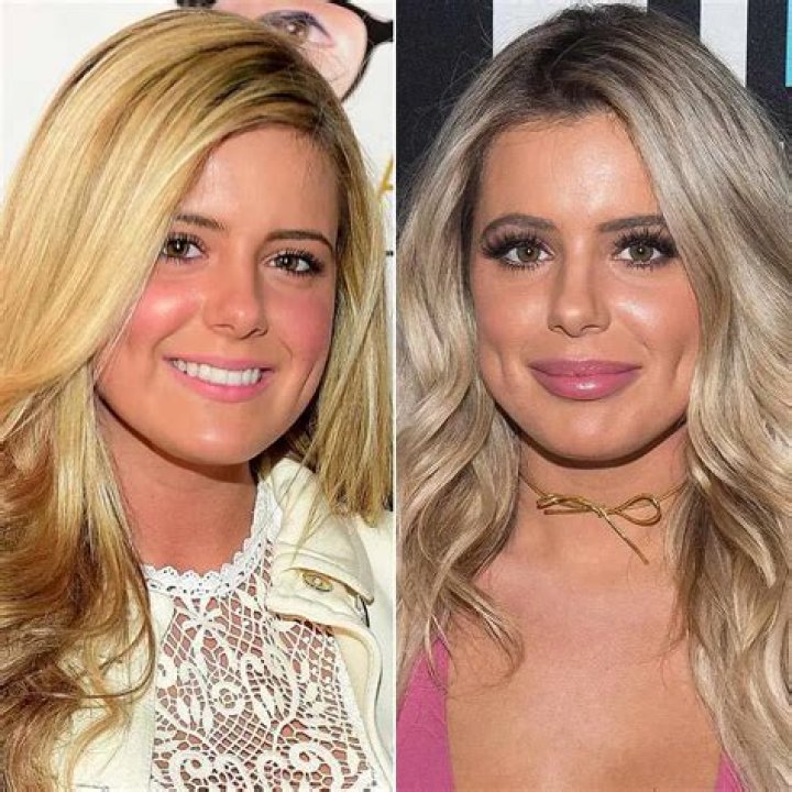 Brielle Biermann Issues Lip Filler Warning with Photos The Daily Dish