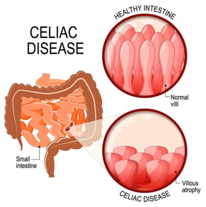 Celiac Disease Archives Life Chiropractic PSL