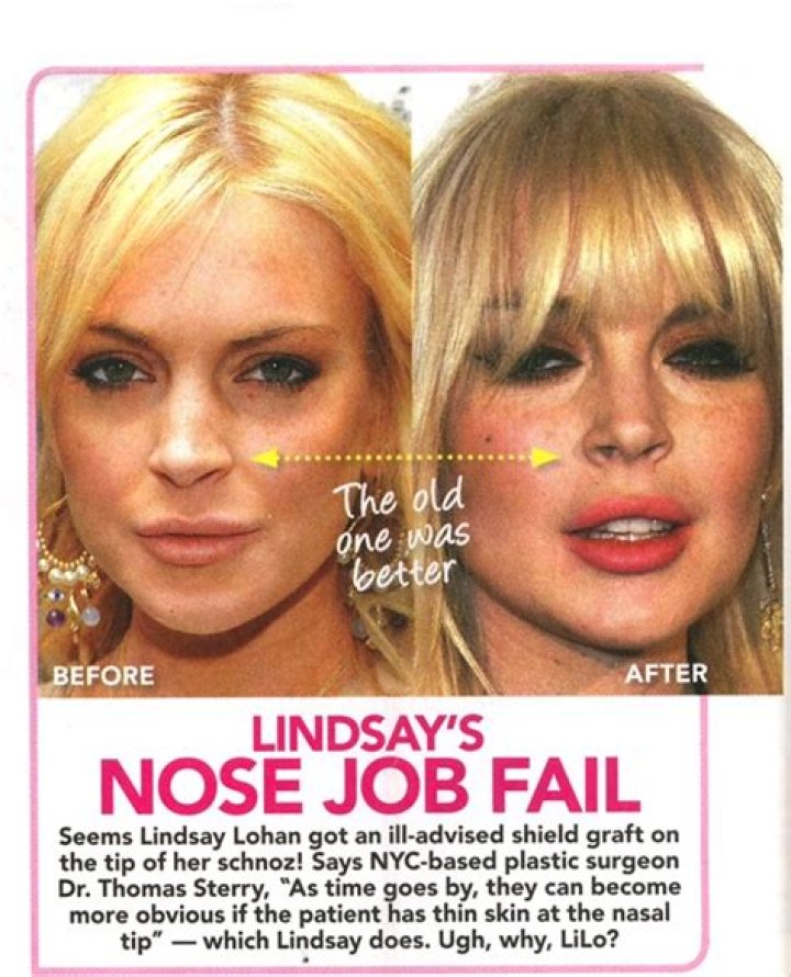 Chatter Busy Lindsay Lohan Nose Job