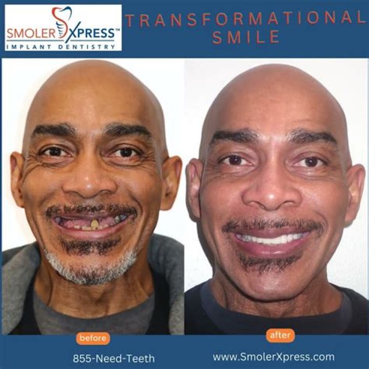 Complete smile transformation!! Created on the Gold Coast with Layered