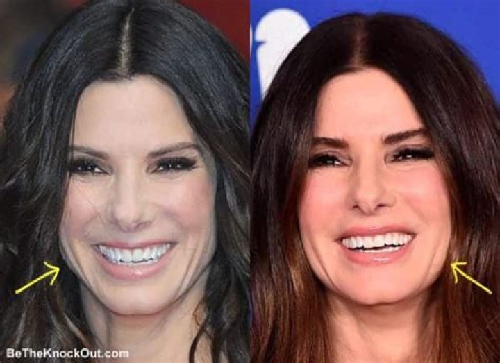 Did Sandra Bullock Have Plastic Surgery? Facial Analysis Cl&iacute;nica de