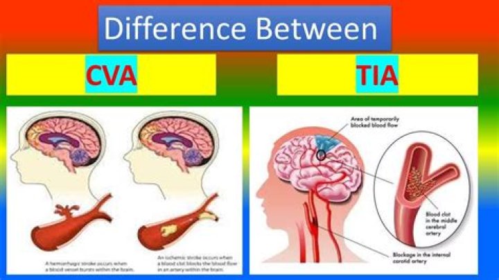 Difference between CVA and TIA YouTube