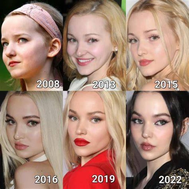Dove Cameron Plastic Surgery + Before and After Pictures