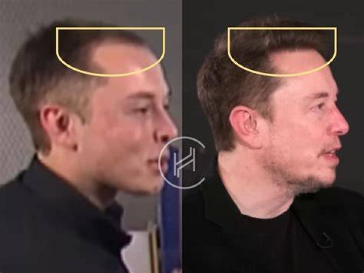 Elon Musk Hair Loss, Shocking Change, How did he do it?