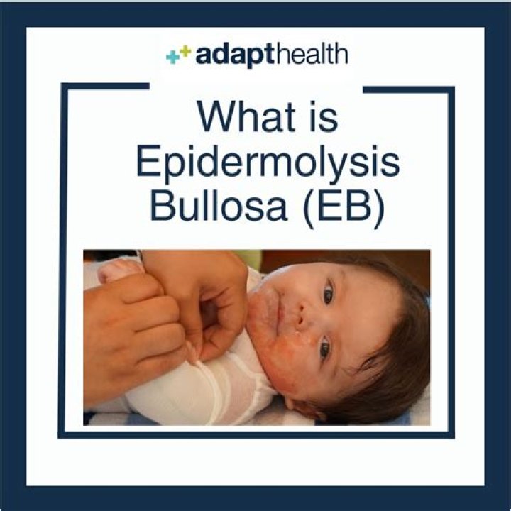 Epidermolysis Bullosa EBawareness eddievedder