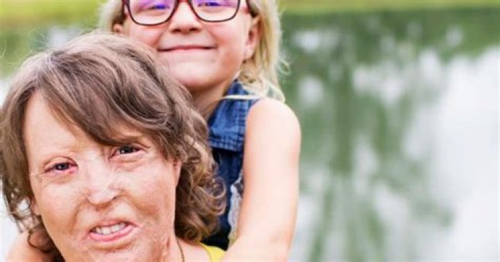 Family says woman left burned in a field in April has died State