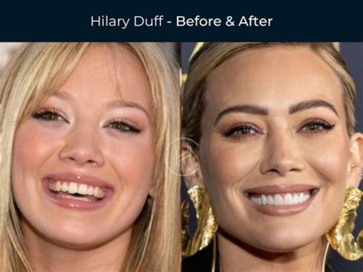 Hilary Duff Veneer / Hilary Duff Veneers Page 1 Line 17qq Com This