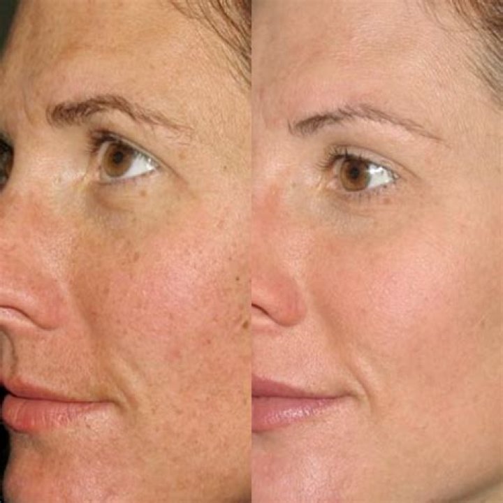 IPL/BBL ruined my skin 6 months later and looking worse than ever