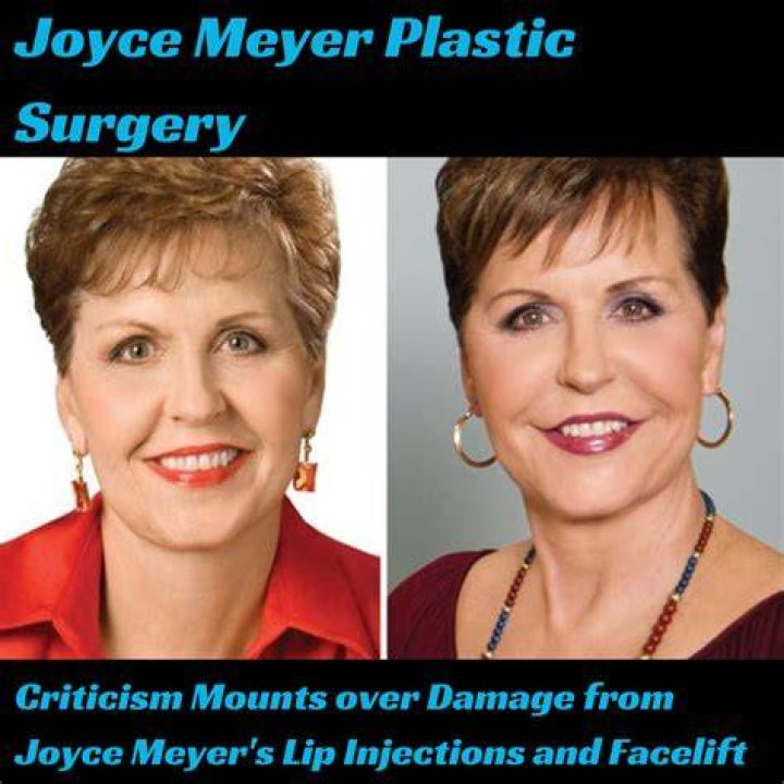 Joyce Meyer Plastic Surgery With Before And After Photos