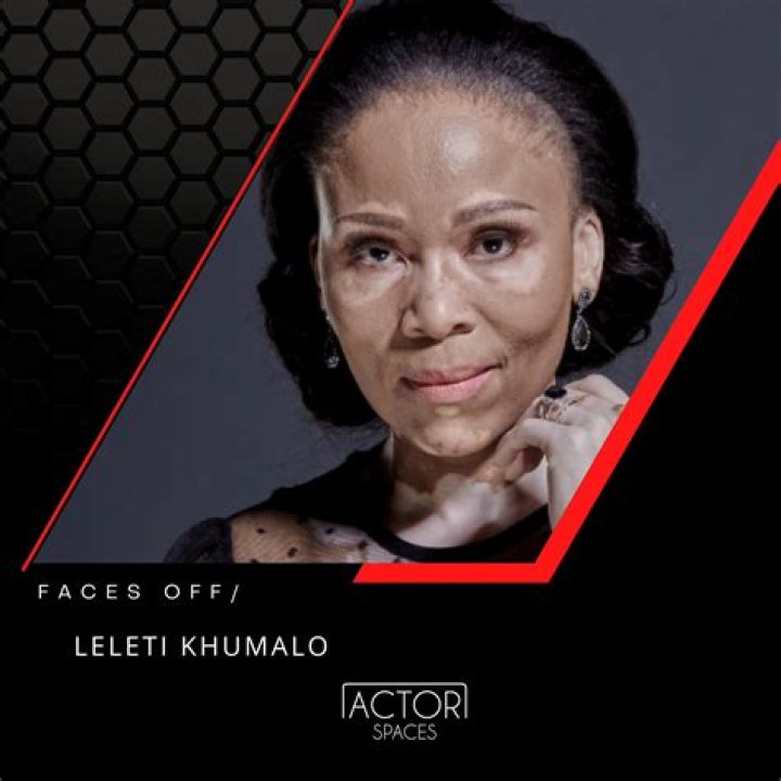 Leleti Khumalo talks about how she learned to accept her skin condition