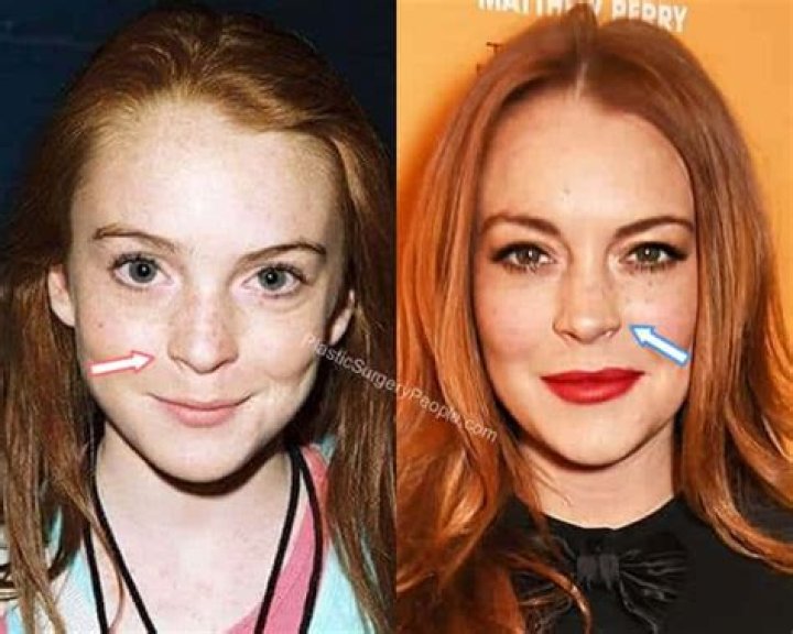 Lindsay Lohan Nose Job