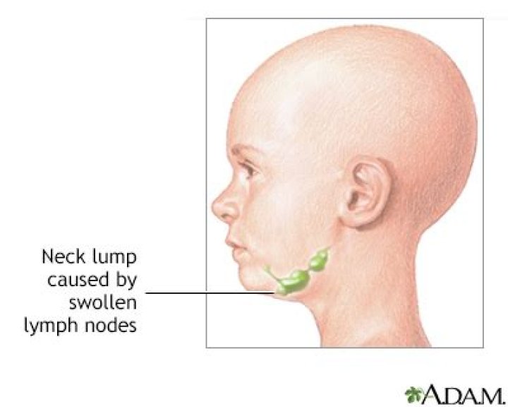Lump under the chin Symptoms and causes