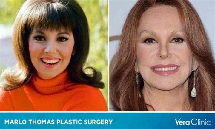 Marlo Thomas Plastic Surgery Did The Actress Get Surgery To Change Her