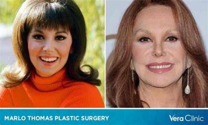 Marlo Thomas Plastic Surgery With Before And After Photos