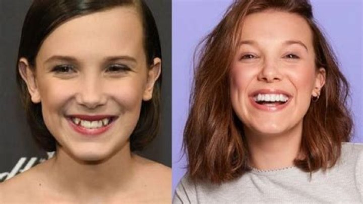 Millie Bobby Brown before and after plastic surgery