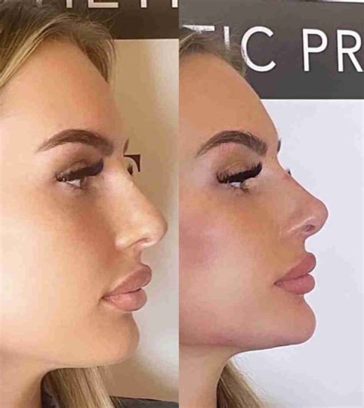 Nose Job And Lip Filler Rumors Update Phòng Giáo dục và Đào tạo Thạnh Phú