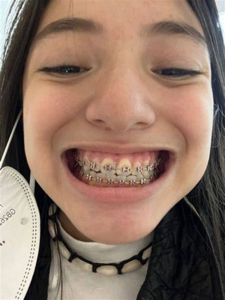 Pin de John Beeson en Girls in Braces Brackets dentales, Ortodoncia