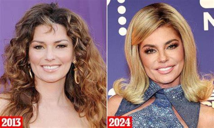 Shania Twain Nose Job Plastic Surgery Photos Before And After