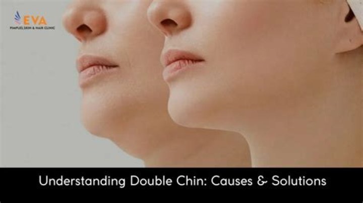 The Causes Of A Double Chin Justinboey