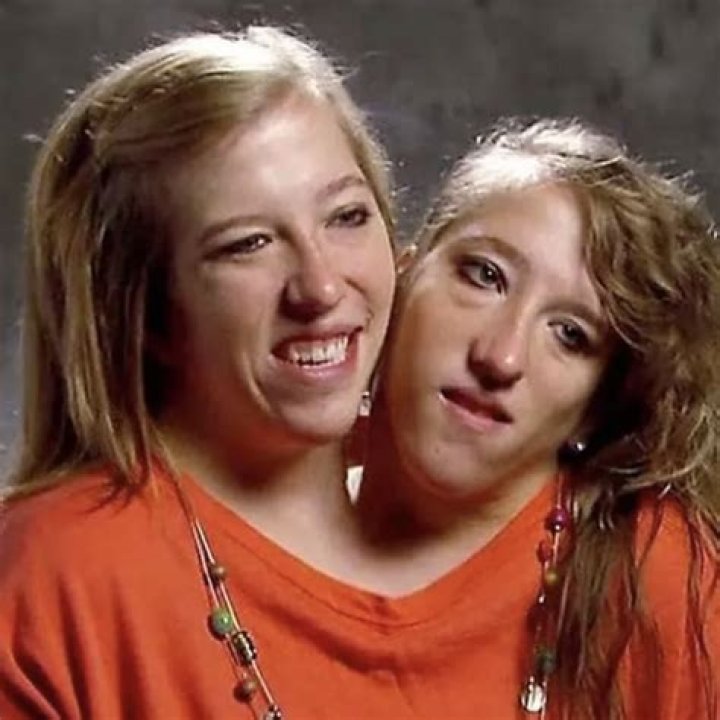 These onceconjoined twins are headed home for Christmas