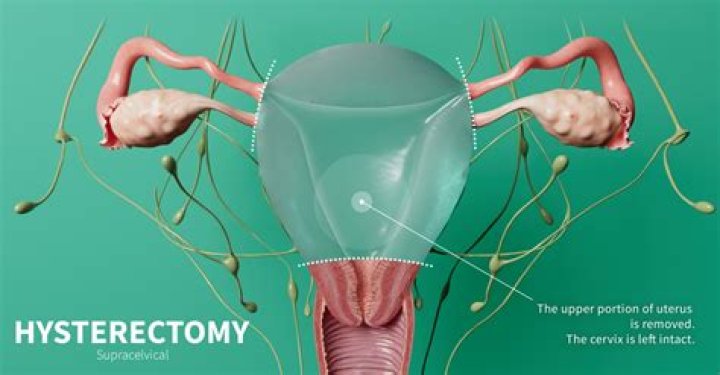 What is a hysterectomy?
